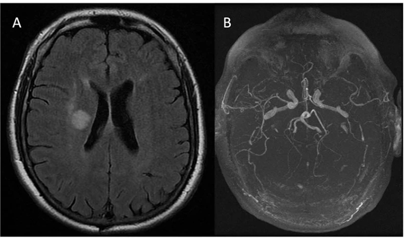Figura 2. A: RM craneal (secuencia T2-FLAIR) muestra lesión isquémica de nueva aparición a nivel de corona radiata derecha. B