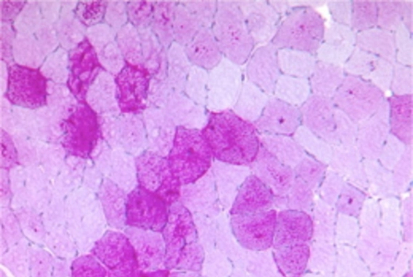 Glykogeneinlagerung in Muskelfasern bei Morbus Pompe