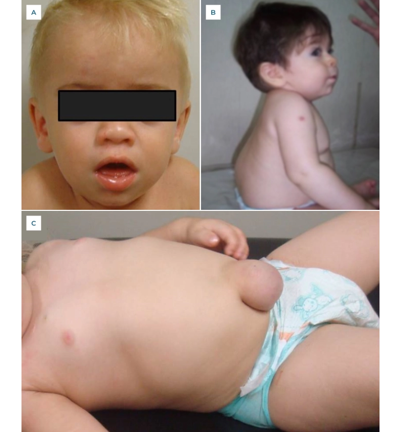 Drei Fotos von Kleinkindern mit unspezifischen Symptomen der MPS 1-Form Morbus Hurler, darunter ein Seitenprofil, eine Frontalaufnahme und eine Aufnahme des Oberkörpers mit sichtbarem Bauchvorfall.