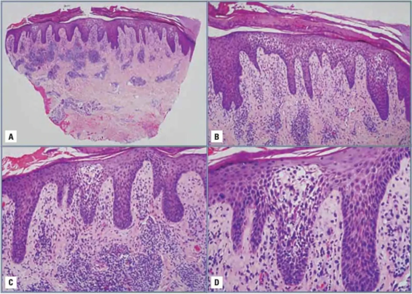 imagen hispatología del eczema