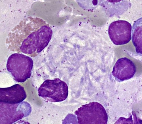 Cellule de Gaucher : Myélogramme d'un patient atteint de la maladie de Gaucher