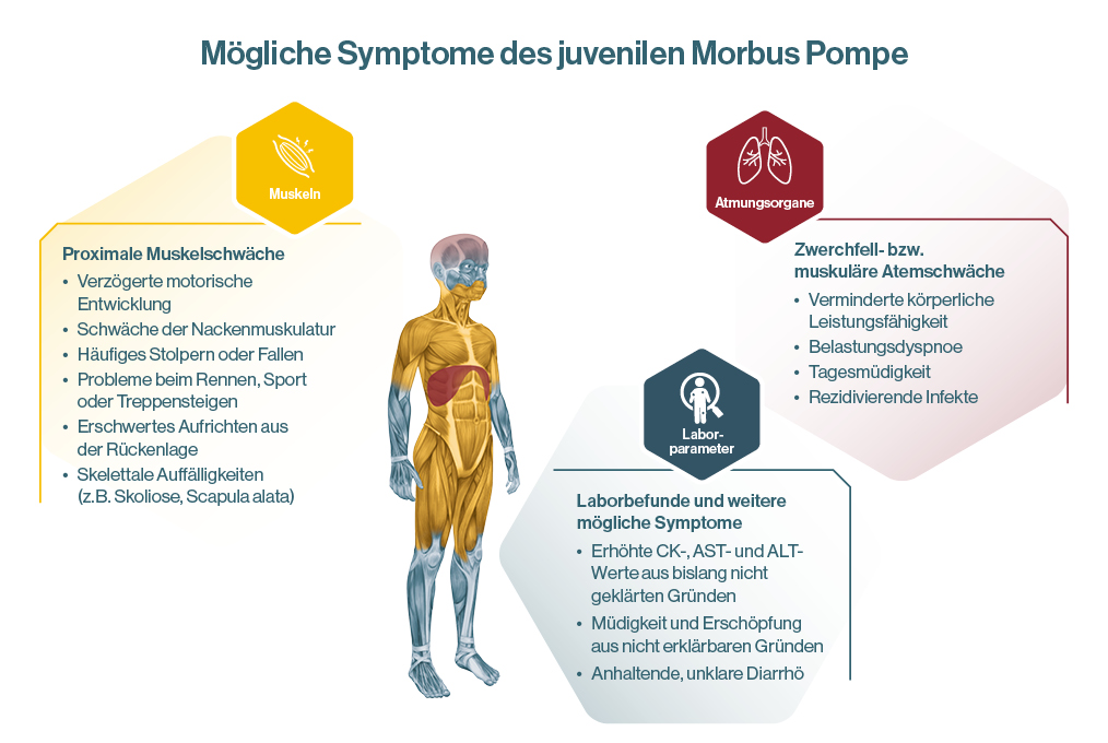 Grafik zeigt mögliche Symptome des juvenilen Morbus Pompe mit farblich markierten Bereichen für Muskeln, Atmungsorgane und Laborparameter sowie einer menschlichen Körperabbildung mit hervorgehobener Muskulatur.