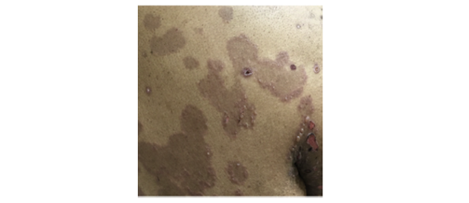 Close-up clinical image of skin showing multiple lesions and discolorations consistent with a dermatological condition.