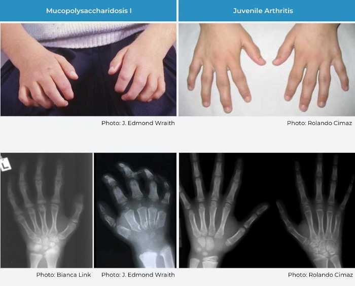Vergleich Gelenkkontrakturen bei MPS 1 vs. bei juveniler idiopathischer Arthritis