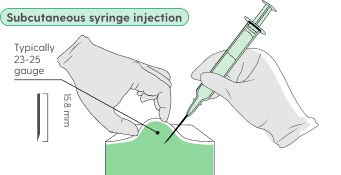 Illustration of subcutaneous syringe injection administration.