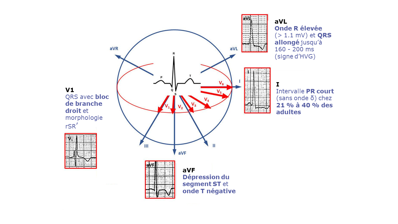 Schéma adapté de Vitale G, et al. Heart 2022 ; 108 : 54-60