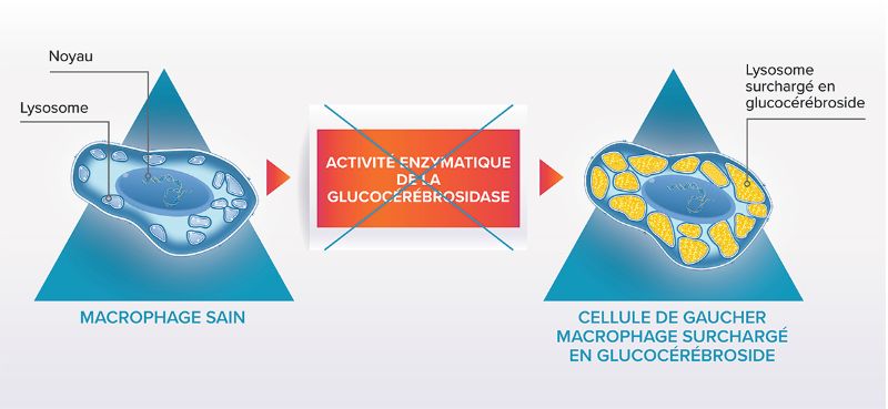 Schéma comparant une cellule normale et une cellule de Gaucher montrant un lysosome surchargé en glucocérébroside.