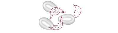 hemolytic anemia figure