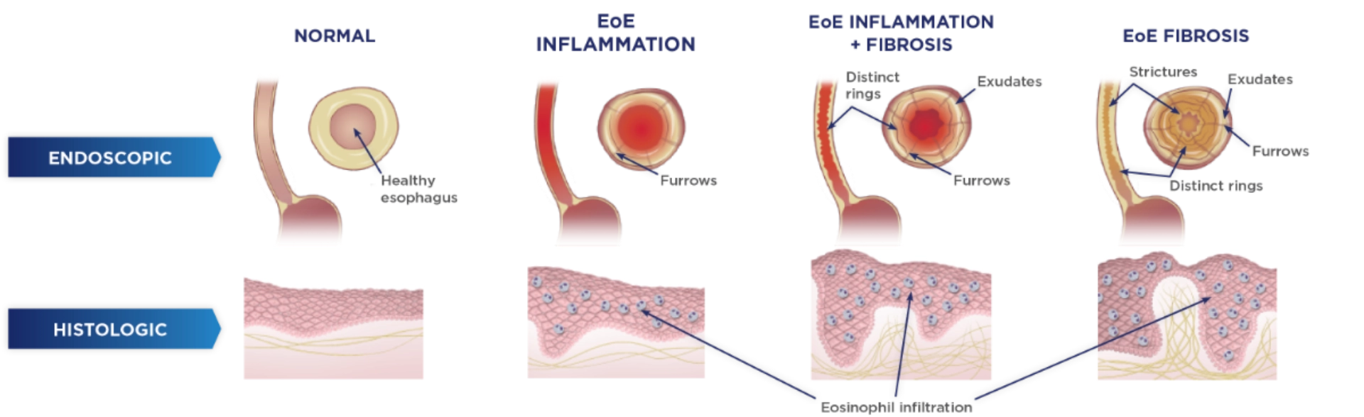 Diagram comparing normal esophagus with stages of eosinophilic esophagitis, showing endoscopic and histologic features including inflammation, fibrosis, furrows, rings, and eosinophil infiltration.