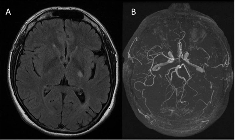 Figura 1. A: RM craneal (secuencia T2-FLAIR) muestra lesión isquémica aguda en brazo posterior de la cápsula interna izquierd
