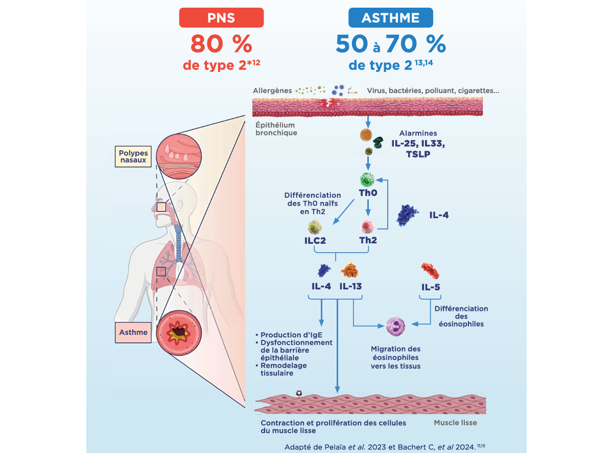 Infographie comparant la pathophysiologie de type 2 entre les troubles PNS (80% de prévalence) et l'asthme (50-70% de prévalence), montrant les déclencheurs communs (allergènes, virus, polluants) et la cascade inflammatoire impliquant les alarmines, cellules Th2, ILC2, production d'IgE et migration des éosinophiles.