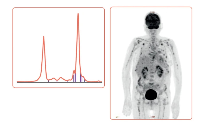 eficacia-tratamiento-isatuximab-carfilzomib-dexametasona-segunda-linea-figura-1-2
