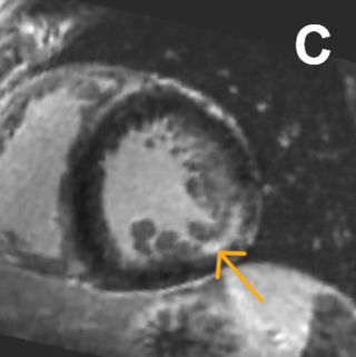 LGE-Aufnahme mit Fibrose in inferolateraler Region