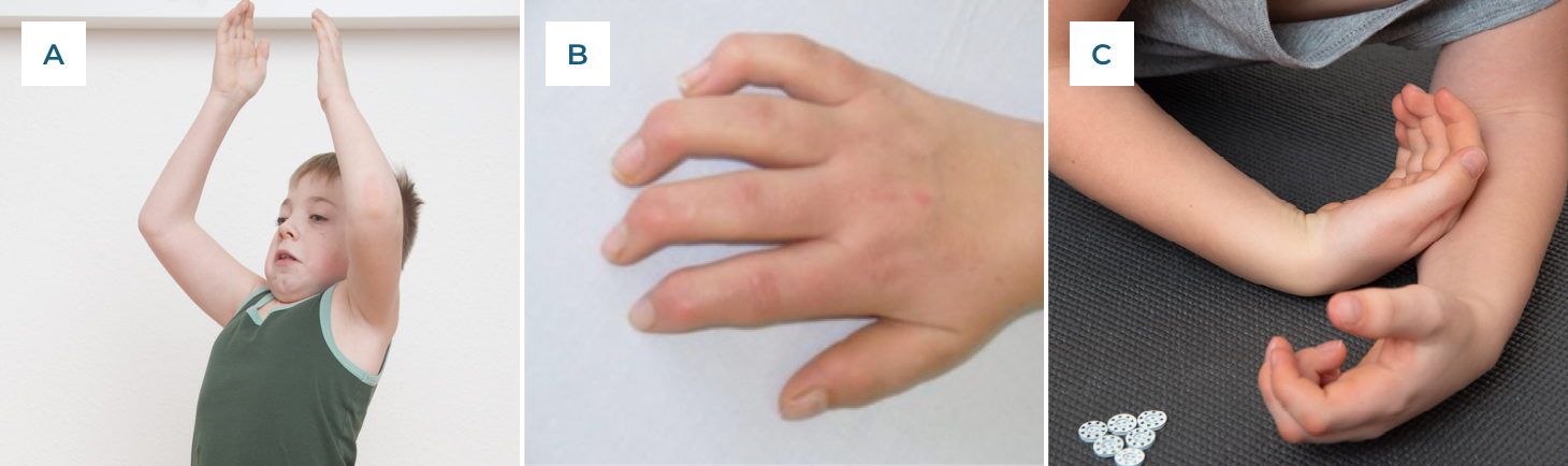 Drei Fotos zeigen verschiedene Hand- und Armhaltungen: erhobene Arme, Hand mit gespreizten Fingern und angewinkelte Handgelenke mit sichtbaren Gelenkverformungen.