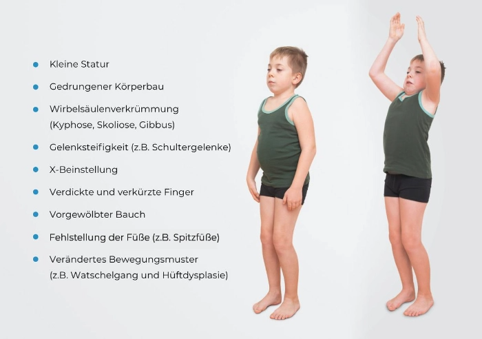 Infografik mit einem Kind zur Blickdiagnose von äußerlichen Merkmalen bei MPS 1