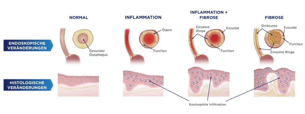 Pathophysiologie der EoE