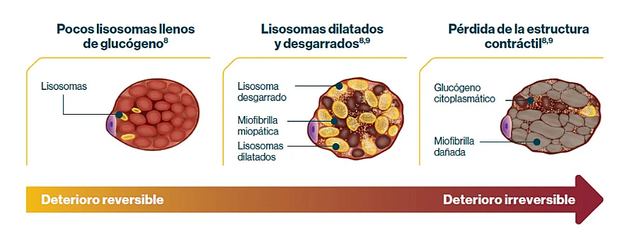 Acumulación de glucógeno lisosómico en la enfermedad de Pompe