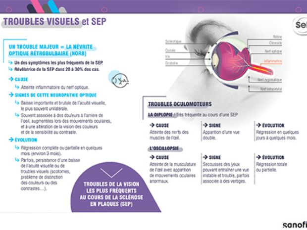 Planche didactique IDE pour expliquer l’anatomie de l’œil avec les symptômes visuel et la basse vision associée à la sclérose