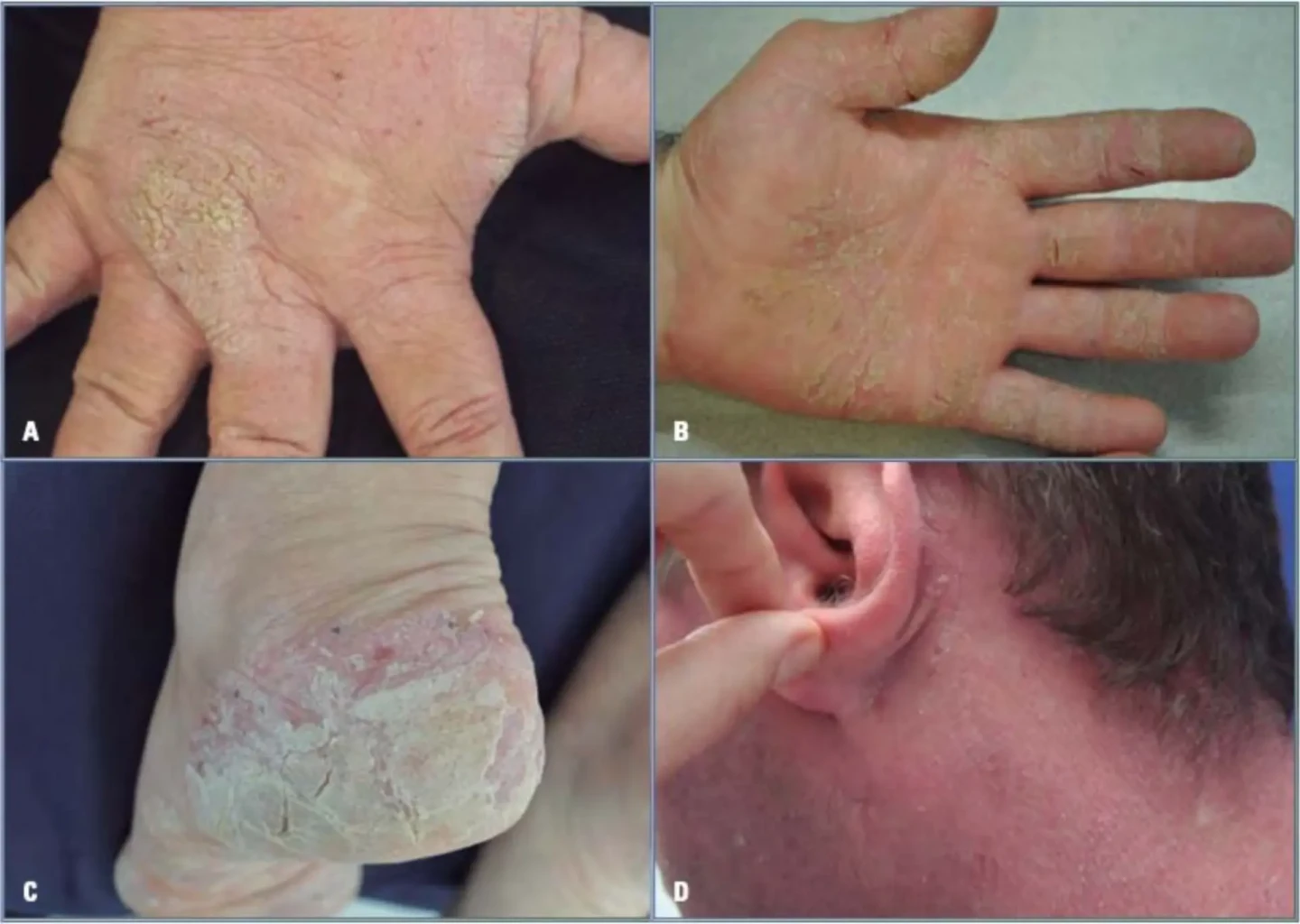 imagen eczema liquenficado