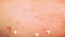 Haut mit mehreren roten, entzündeten Stellen, darunter drei weiße Pfeile, die auf die Hautstellen zeigen.