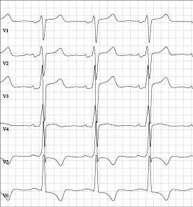 Schwarz-weißes EKG mit sechs Ableitungen V1 bis V6, zeigt regelmäßige Herzschläge mit charakteristischen Zacken.