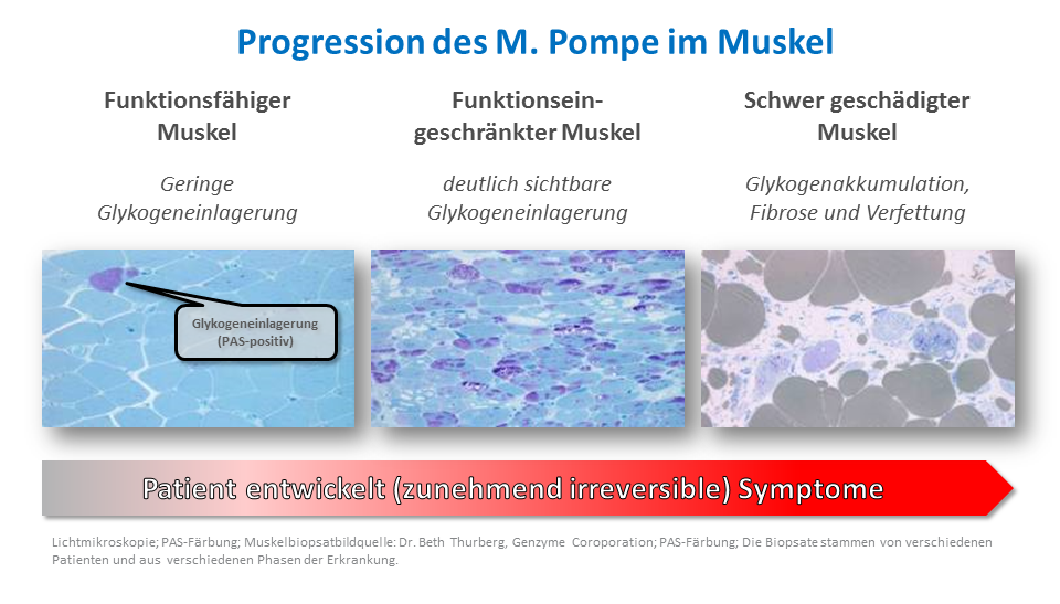 Drei Mikroskopaufnahmen zeigen die Progression des Muskels M. Pompe von funktionsfähigem Muskel mit geringer Glykogeneinlagerung über eingeschränkten Muskel mit deutlich sichtbarer Glykogeneinlagerung bis zu schwer geschädigtem Muskel mit Glykogenakkumulation, Fibrose und Verfettung.