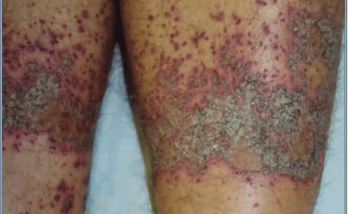 eczema irritantes químicos