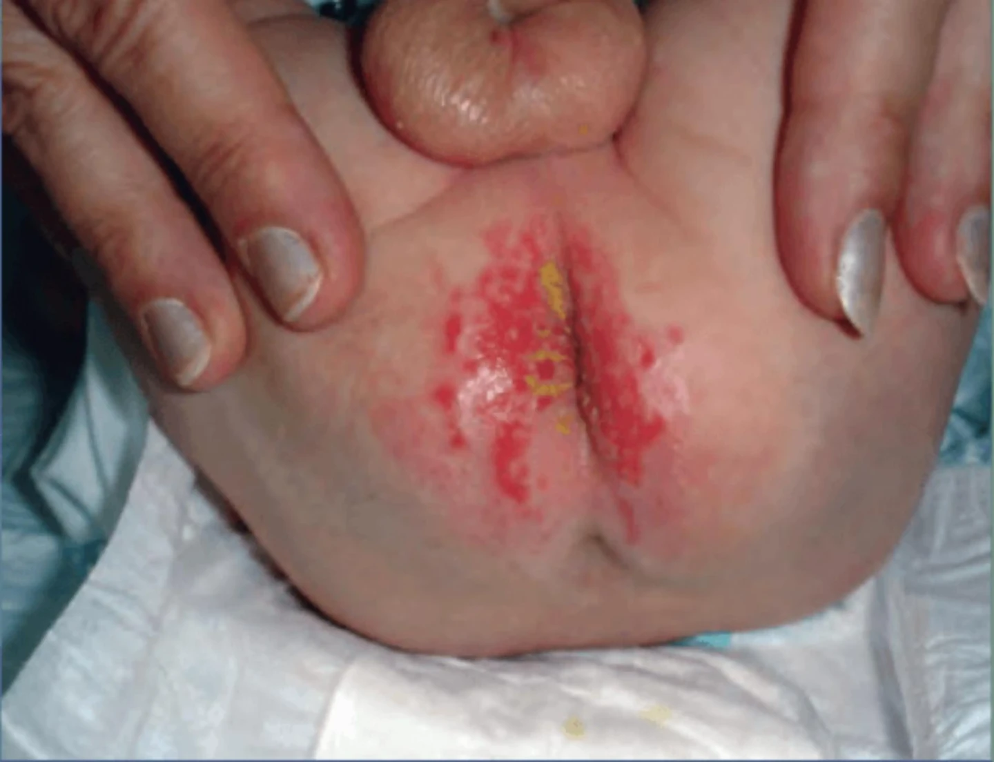 imagen dermatitis pañal