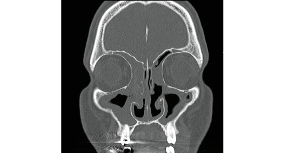 ct-scan-xl