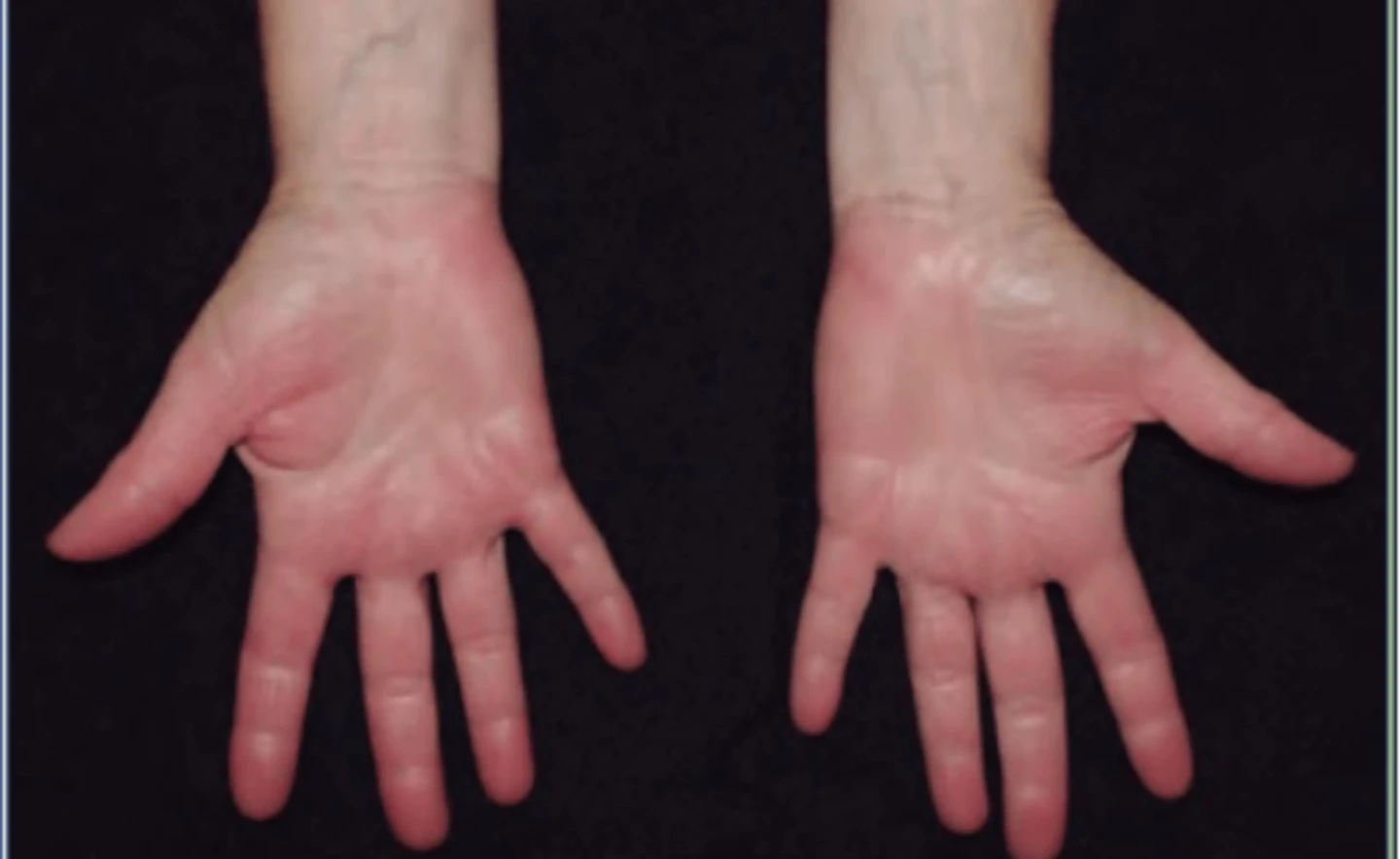 eczema contacto irritativo crónico