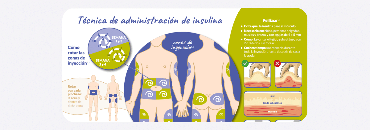 Zonas de rotación para la inyección de insulina en diabetes