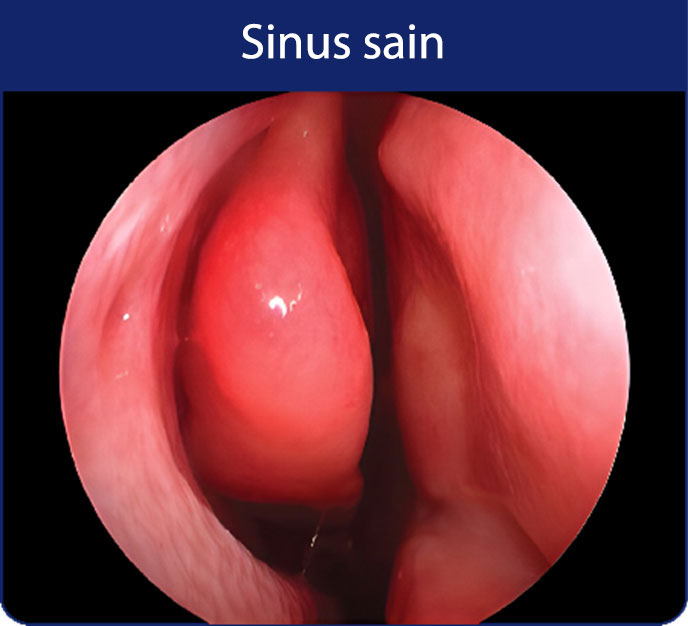 polypes-sinus-sain