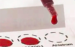 Roter Blutstropfen fällt aus einer Pipette auf ein Testfeld des Trockenbluttests bei Morbus Gaucher