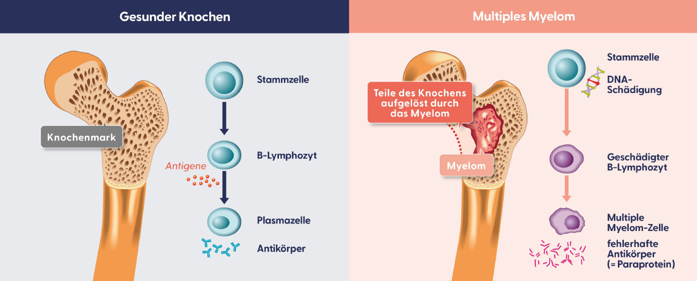 Das Multiple Myelom schädigt die Knochen