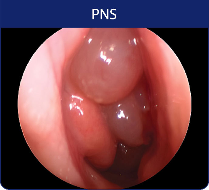 polypes-pns