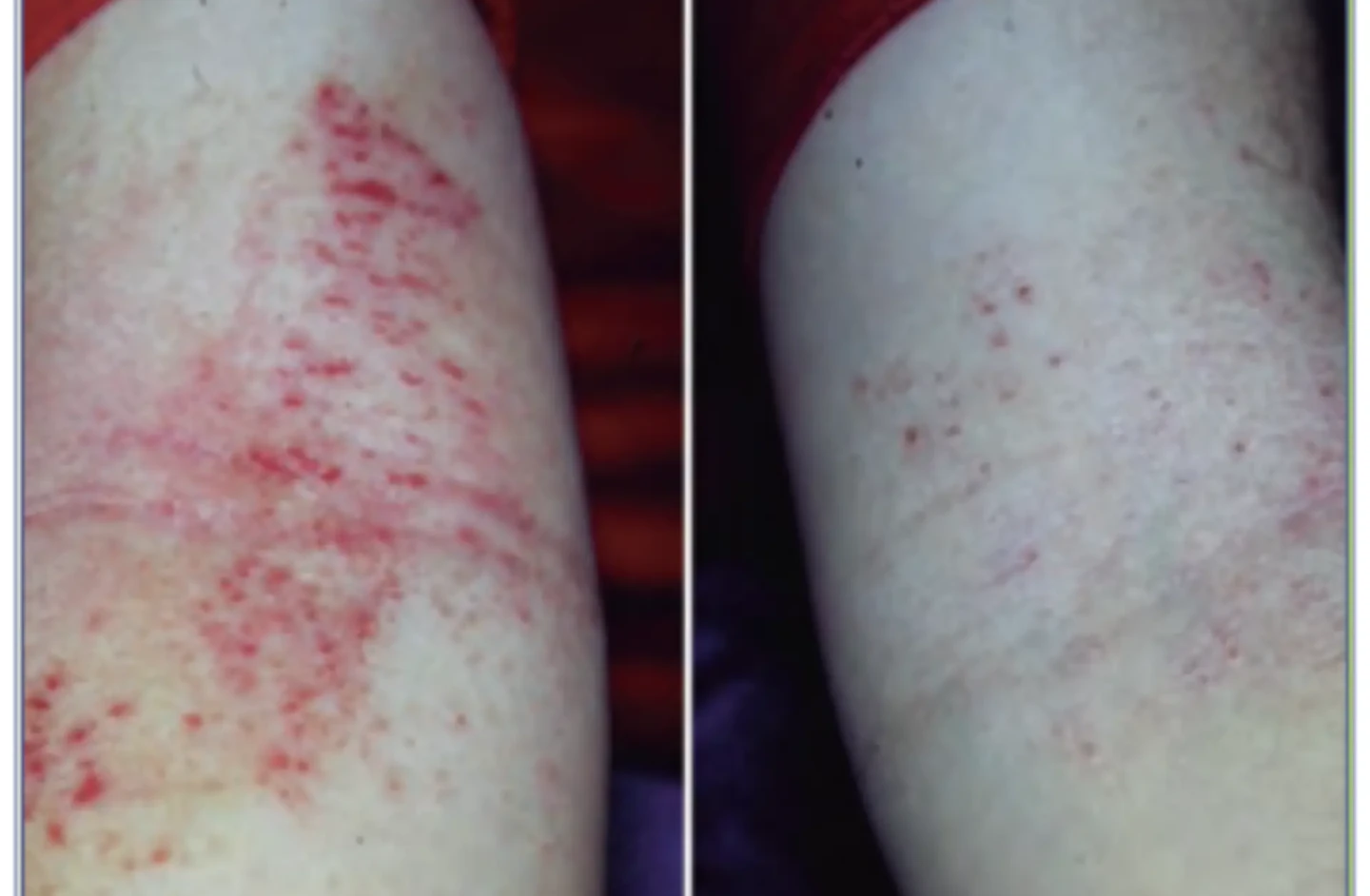 imagen dermatitis atopica infantil