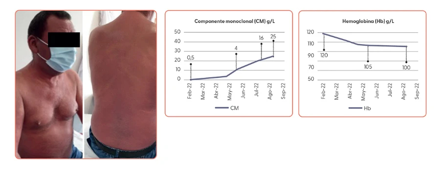eficacia-tratamiento-isatuximab-carfilzomib-dexametasona-segunda-linea-figura-3-4-5