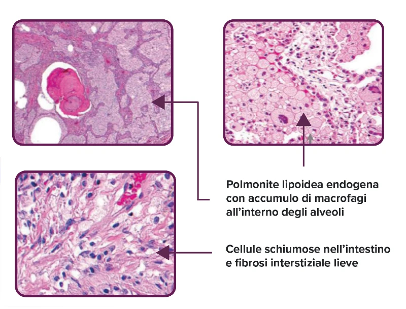 alveoli-polmoni-con-ASMD