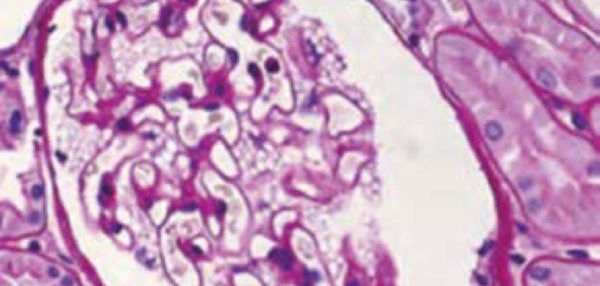 Mikroskopische Aufnahme einer Nierenbiopsie mit violett gefärbten Gewebestrukturen und Zellkernen.