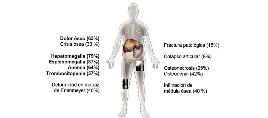 enfermedad-gaucher-diagnostico
