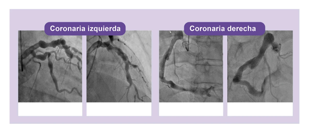 coronariografia-caso-clinico-1