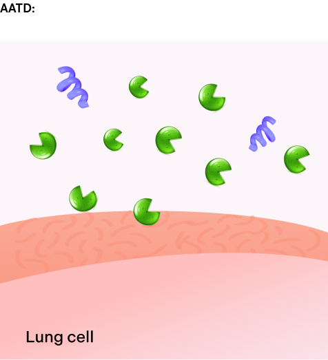 Illustration of AAT protein and elastase imbalance in AATD