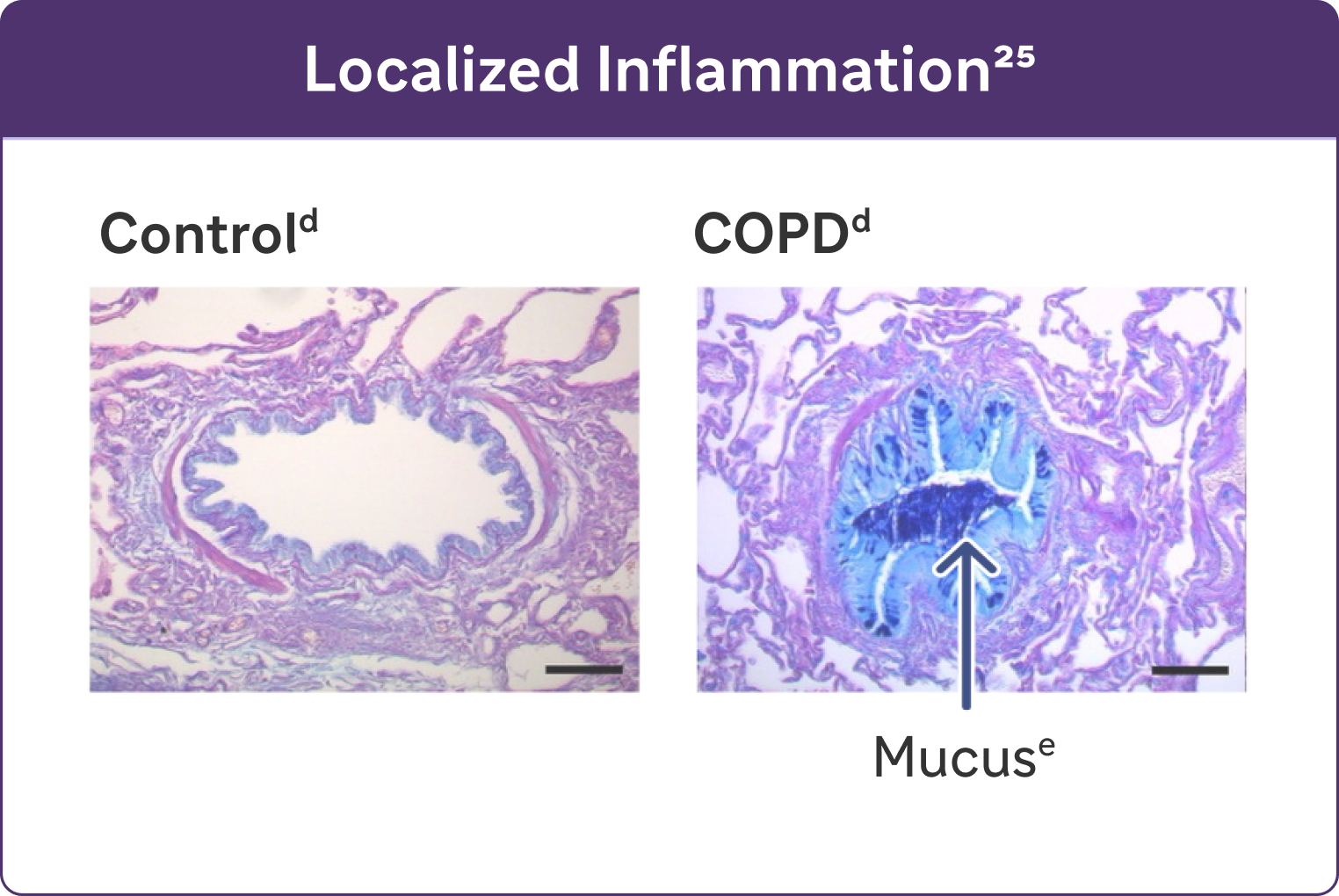 Localized Inflammation : Illustration representing mucus in control next to illustration representing mucus in COPD
