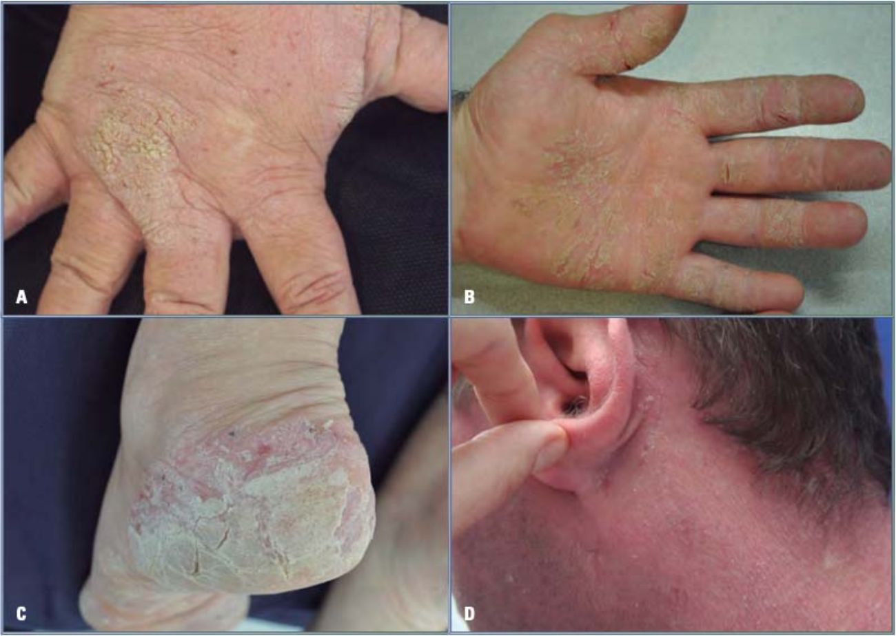 caracteristicas-ezcema-dermatitis-3