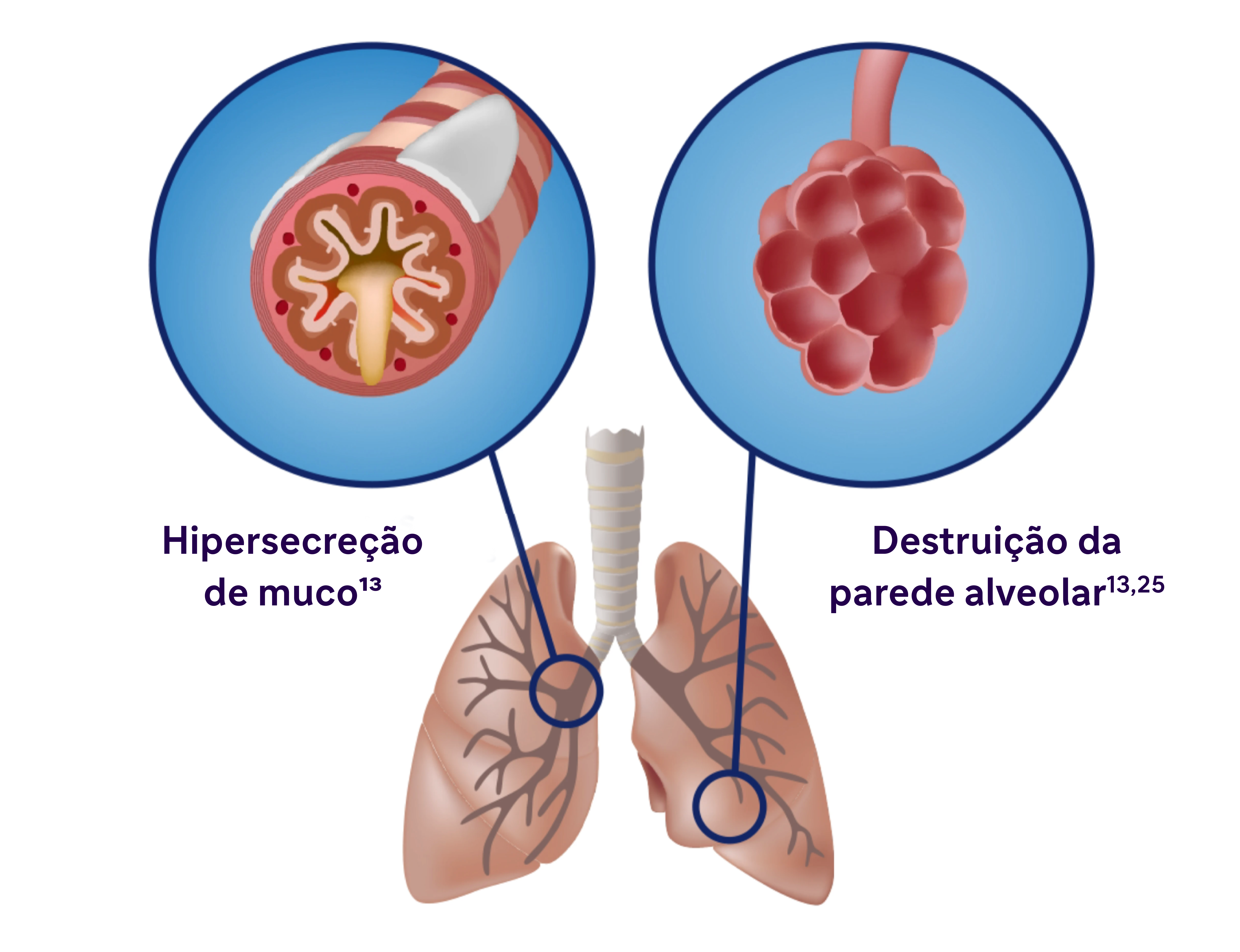 Hipersecreção de muco y estruição da parede alveolar