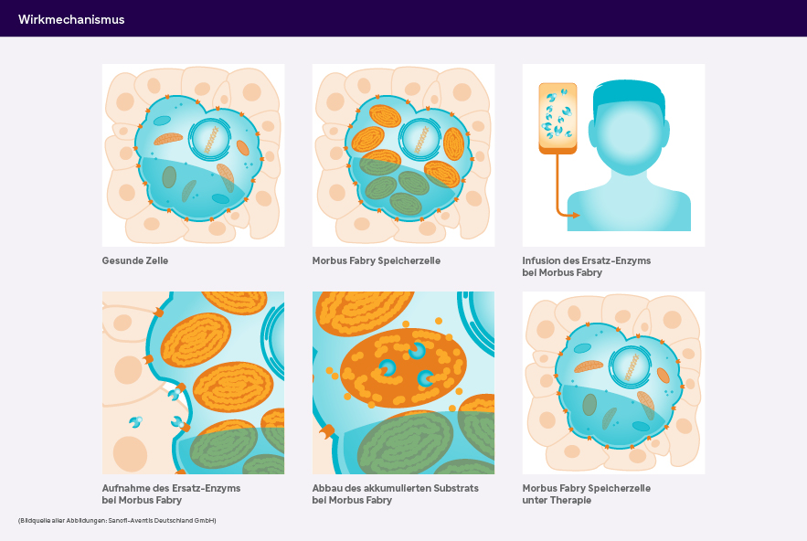 Eine Infografik zeigt den Wirkmechanismus der Morbus-Fabry-Therapie mit einer Enzyminfusion und Zellveränderungen.