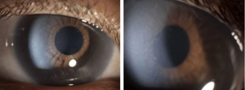 Nahaufnahmen von zwei Augen, eines mit klarer Hornhaut, das andere mit trüber Hornhaut bei MPS 1.