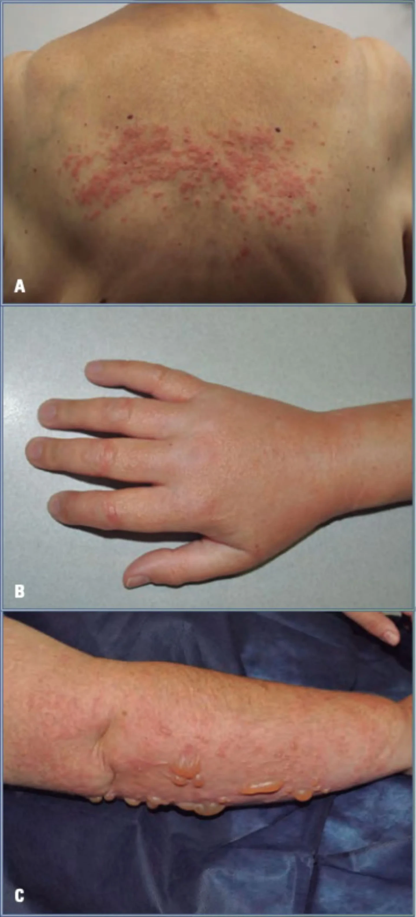 imagen eczema agudo