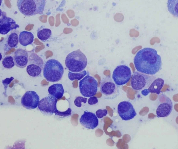Celulas-plasmticas-mieloma-multiple (1)