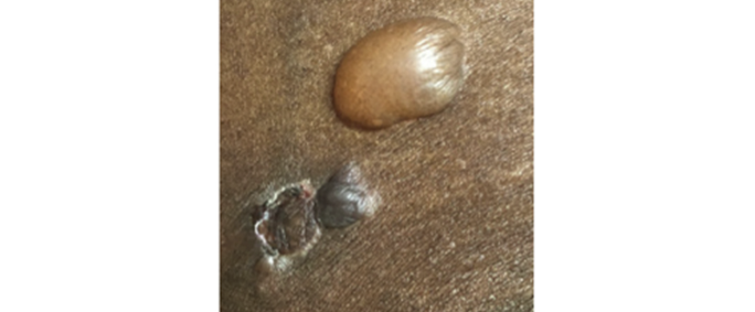 Close-up image of skin showing fluid-filled blisters and an open lesion consistent with a dermatological condition.